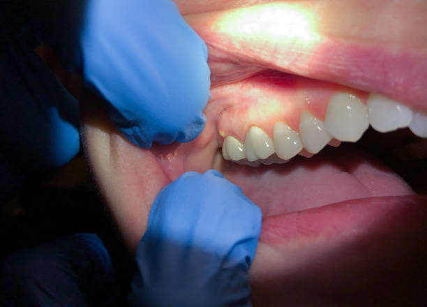 Best Emergency Treatment for Dental Infections or Abscesses in Coshocton, OH
